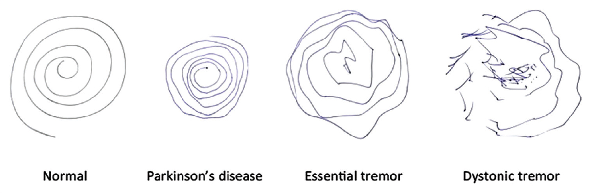 AnnIndianAcadNeurol 2016 19 4 433 194409 f9